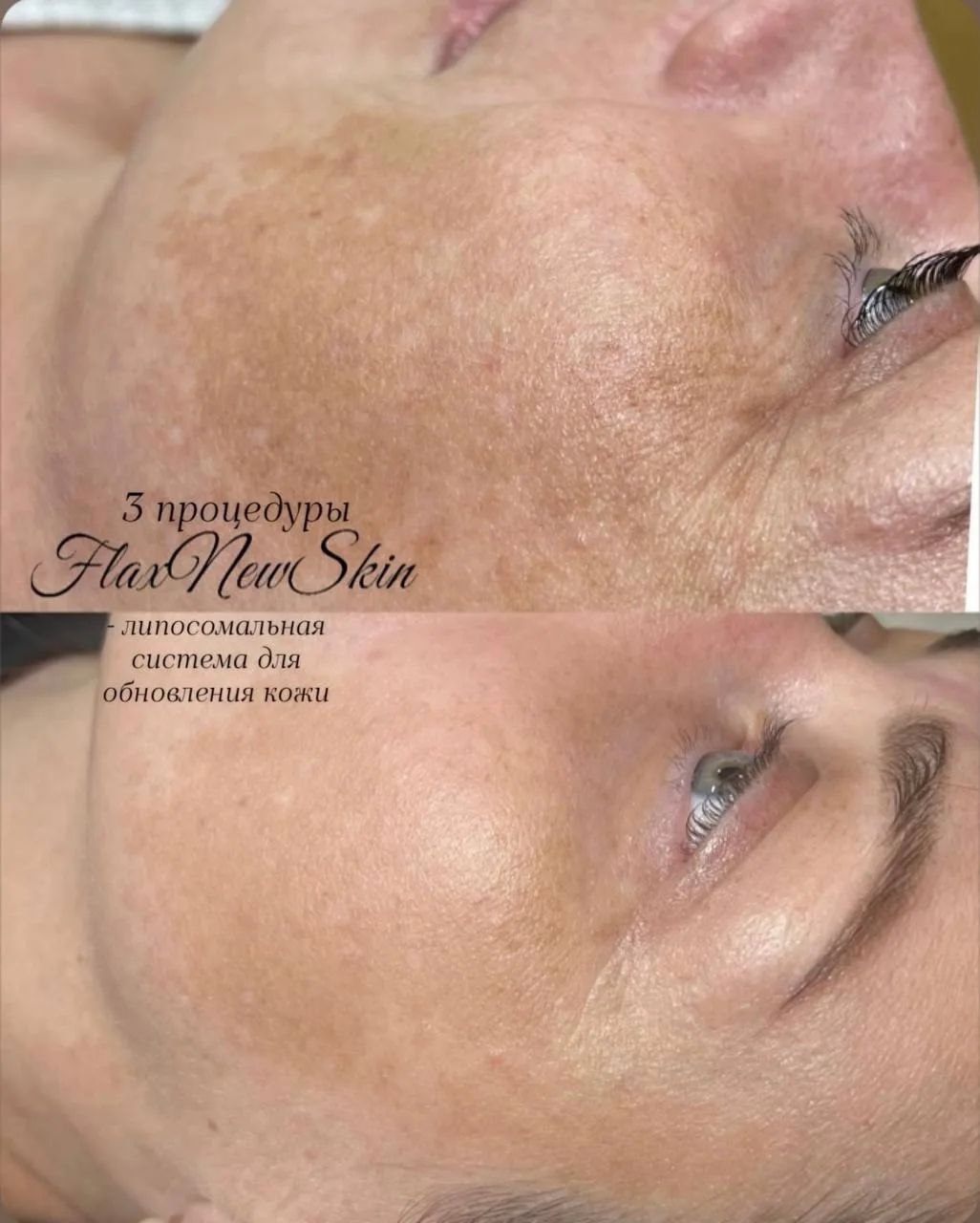 Результат: липосомальное обновление кожи FlaxNewSkin