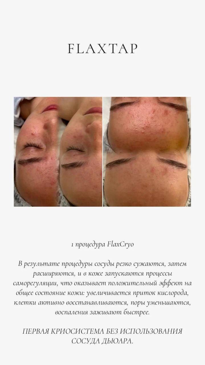 Результат: криопроцедура FlaxCryo