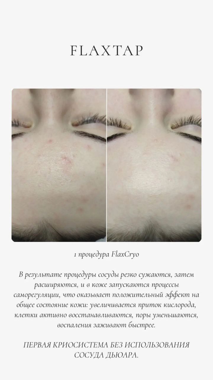 Результат: сужение пор FlaxCryo