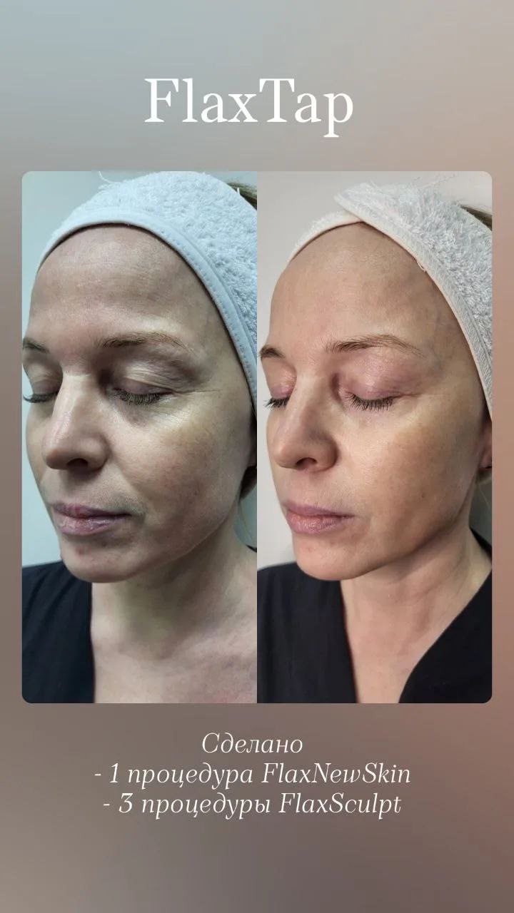 Результат: лифтинг FlaxNewSkin + FlaxSculpt